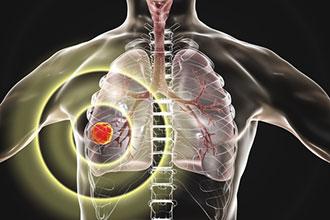 疫情期间肺癌患者如何管理健康？
